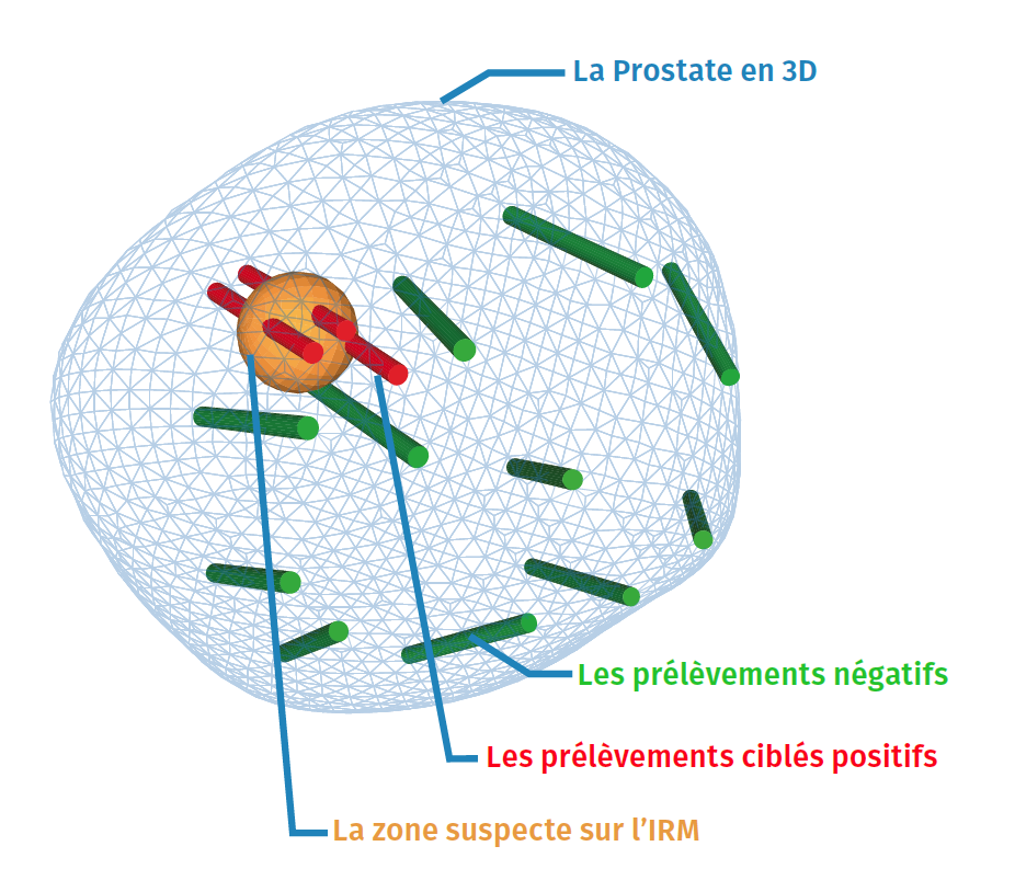 https://www.urologie-foch.fr/wp-content/uploads/2019/12/Prostate-Koelis.png